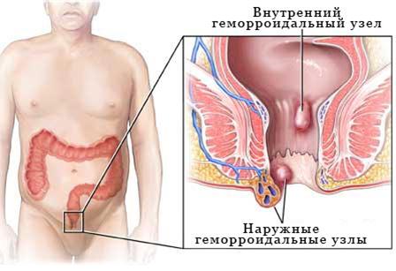 Геморрой